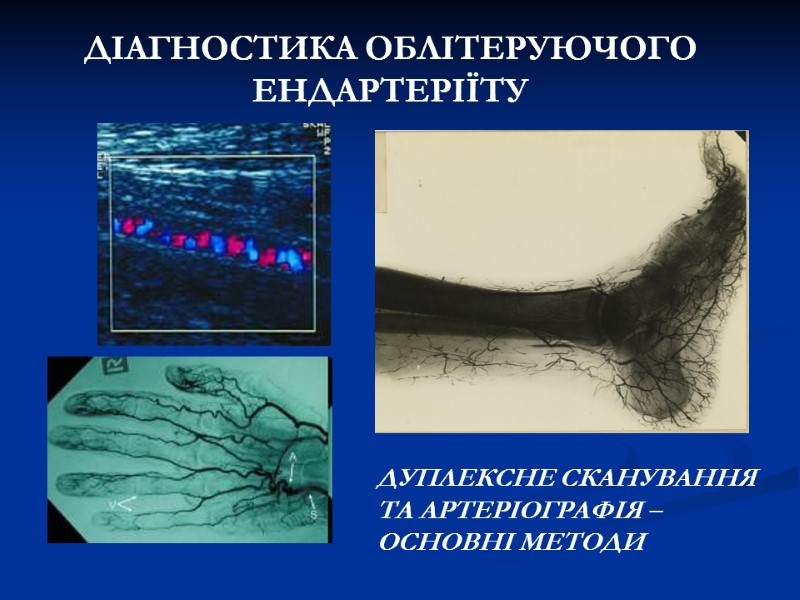 ДІАГНОСТИКА ОБЛІТЕРУЮЧОГО ЕНДАРТЕРІЇТУ ДУПЛЕКСНЕ СКАНУВАННЯ ТА АРТЕРІОГРАФІЯ – ОСНОВНІ МЕТОДИ ДІАГНОСТИКА ОБЛІТЕРУЮЧОГО ЕНДАРТЕРІЇТУ ДУПЛЕКСНЕ СКАНУВАННЯ ТА АРТЕРІОГРАФІЯ – ОСНОВНІ МЕТОДИ